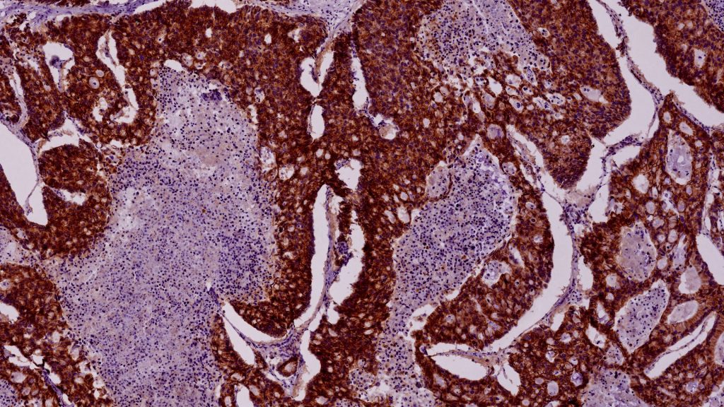 Sweet cure? Sugar substitute may give cancer a run for its money, study hints