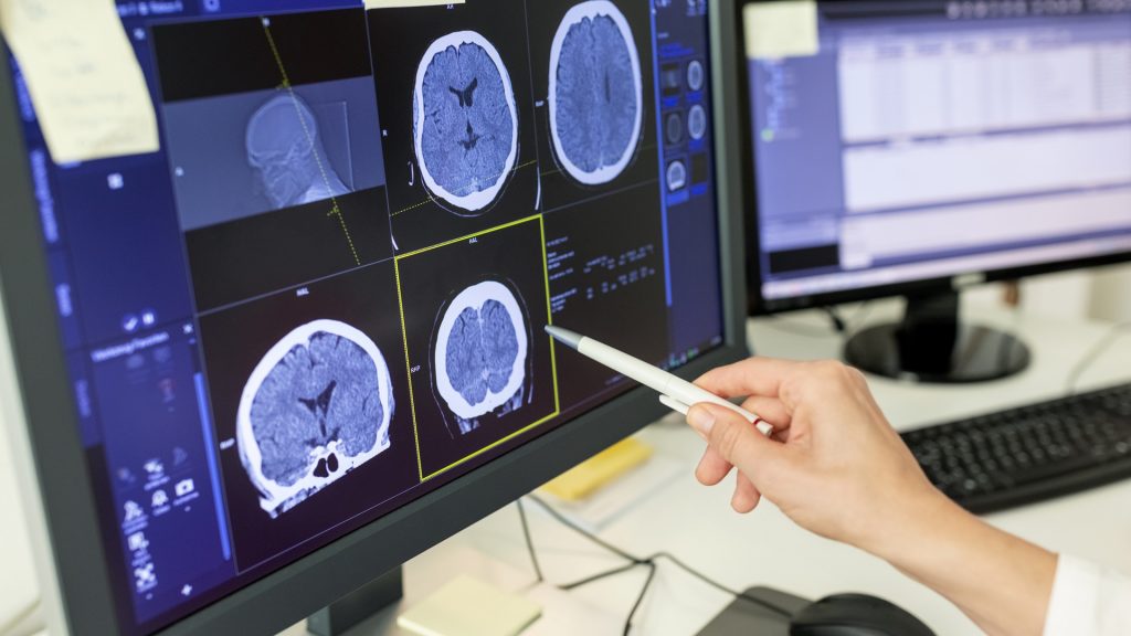 How smart choices and quicker response can outsmart stroke